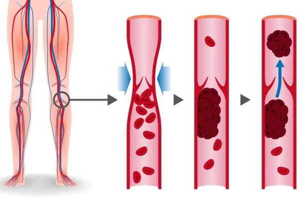 What Are the Symptoms of DVT?