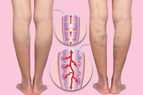 What Causes Deep Vein Thrombosis (DVT)?