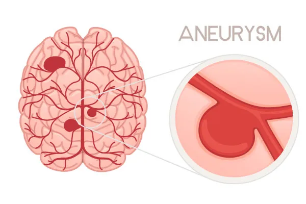 Endovascular Coiling for Brain Aneurysms