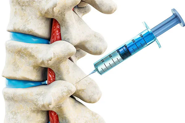 Benefits of Facet Joint Injections