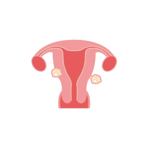 uterine fibroid