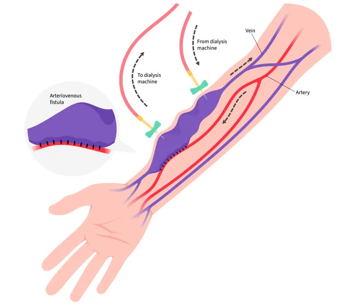 How Does AV Fistula Salvage Work?