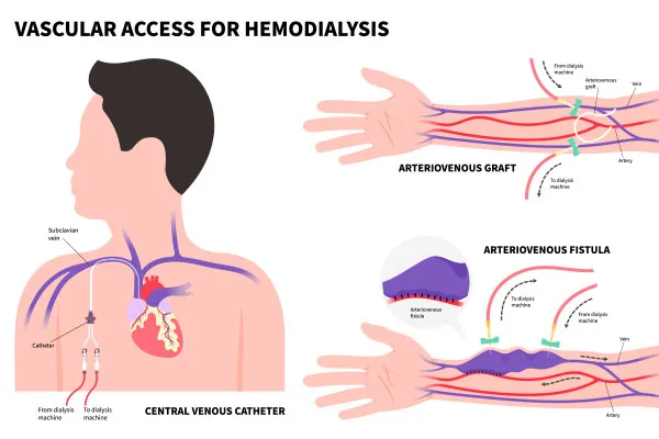 Types of Hemodialysis Catheters