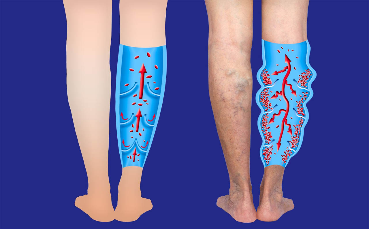 Surgery Vs Laser Treatment for Varicose Veins