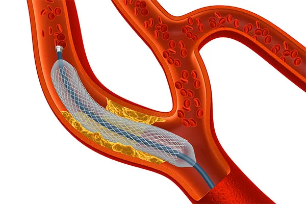 Why is Intracranial Angioplasty and Stenting Needed?