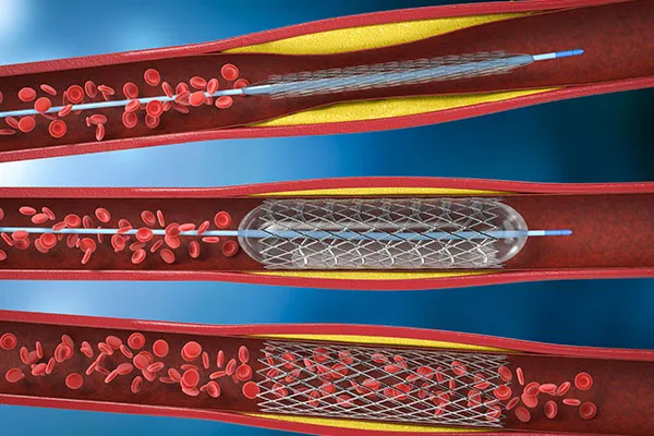 Factors Affecting Mechanical Thrombectomy Outcomes