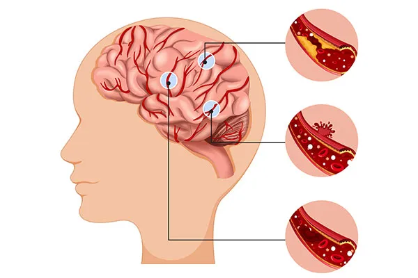 How Does Mechanical Thrombectomy Help in Stroke Treatment?