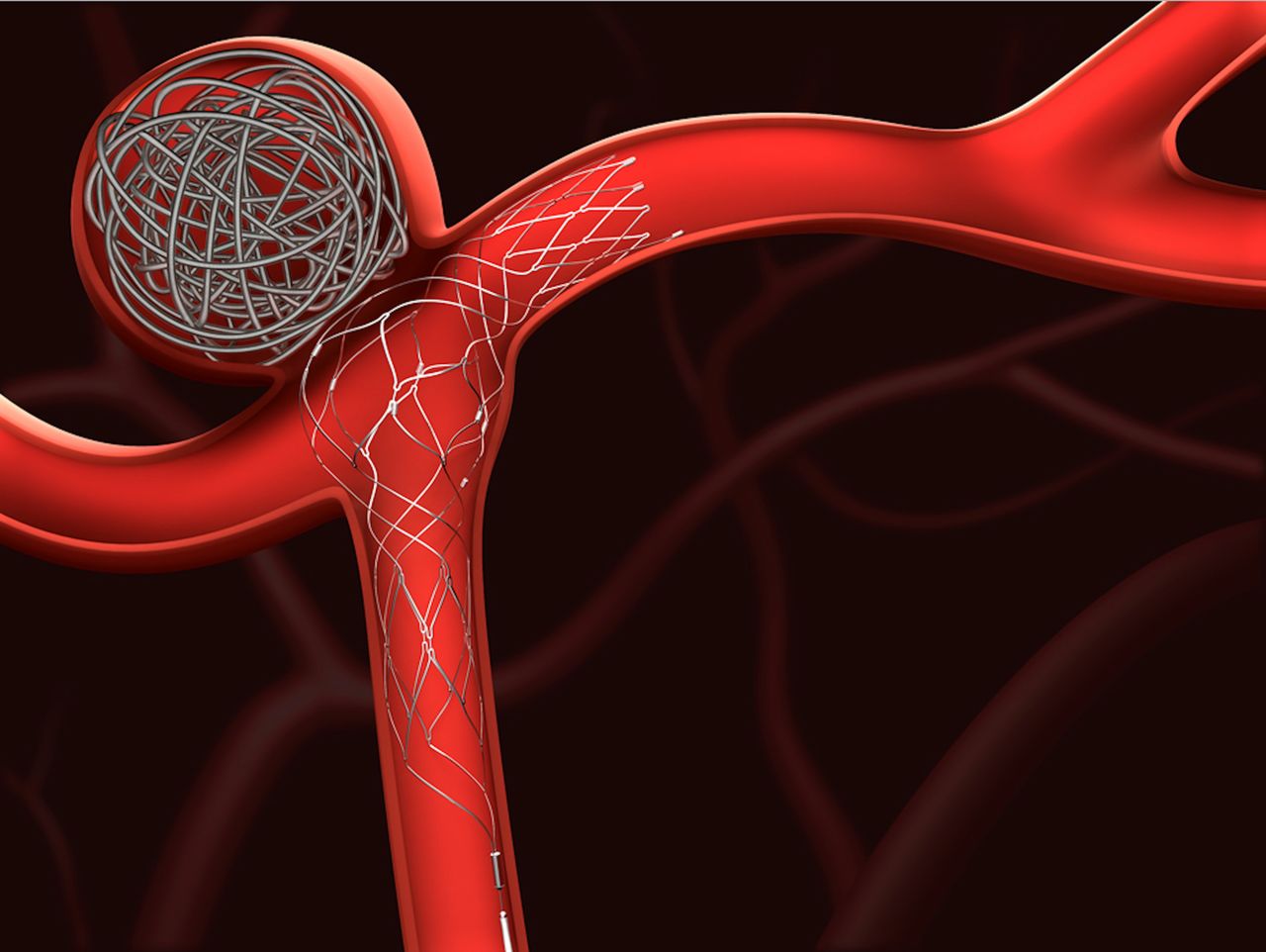 Coiling for Brain Aneurysm