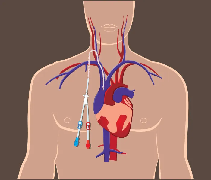 How Does the Permcath Insertion Procedure Work?