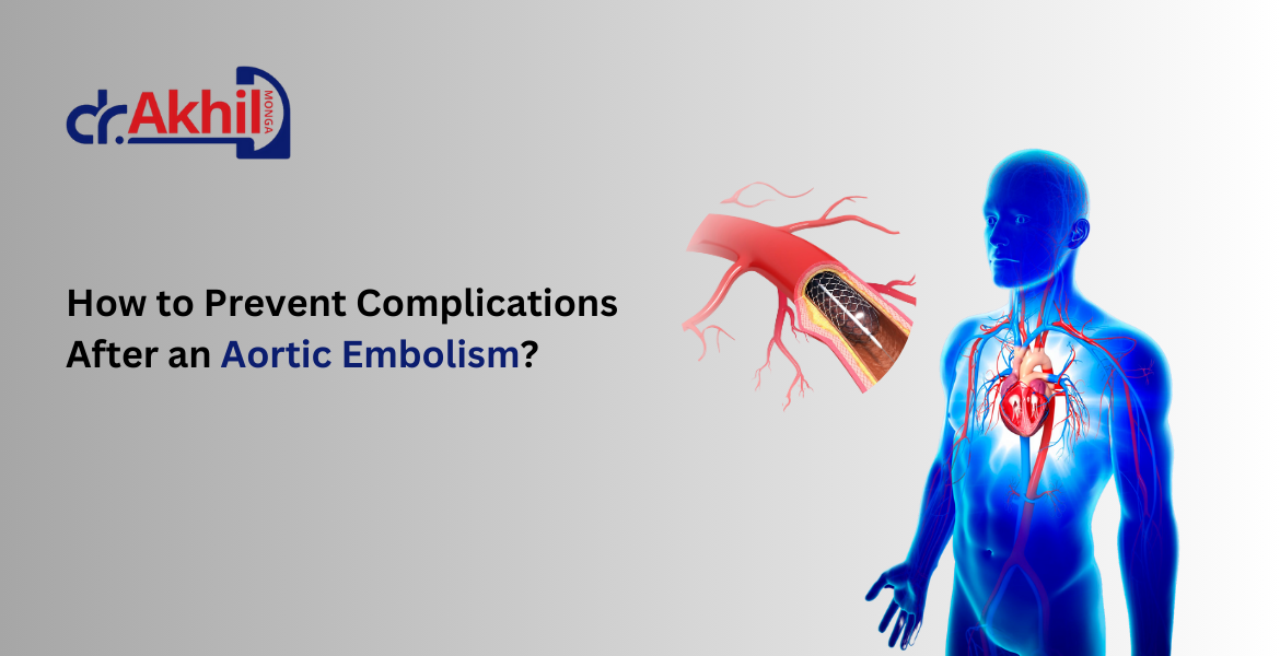 Medical illustration of aortic embolism showing blood clot blocking the aorta