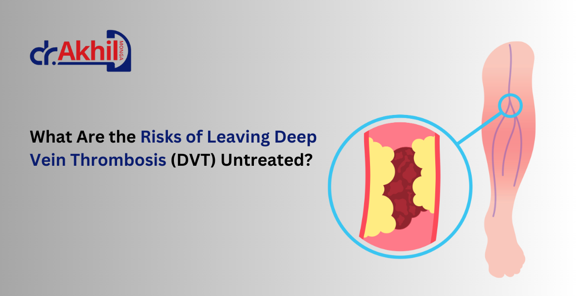 Illustration of Deep Vein Thrombosis (DVT) showing a blood clot in a leg vein