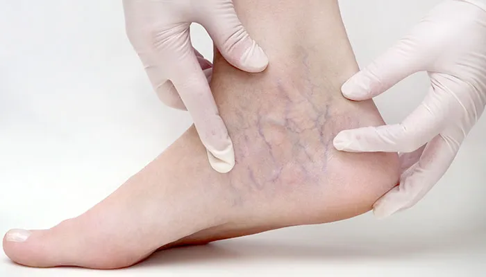 How Does Sclerotherapy Work?