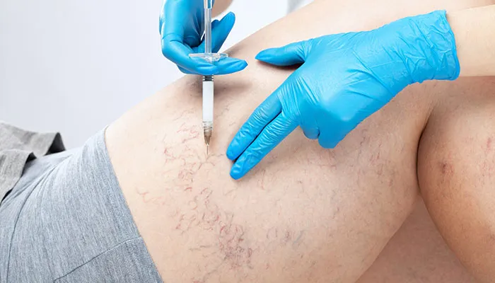 Who Can Benefit from Sclerotherapy?