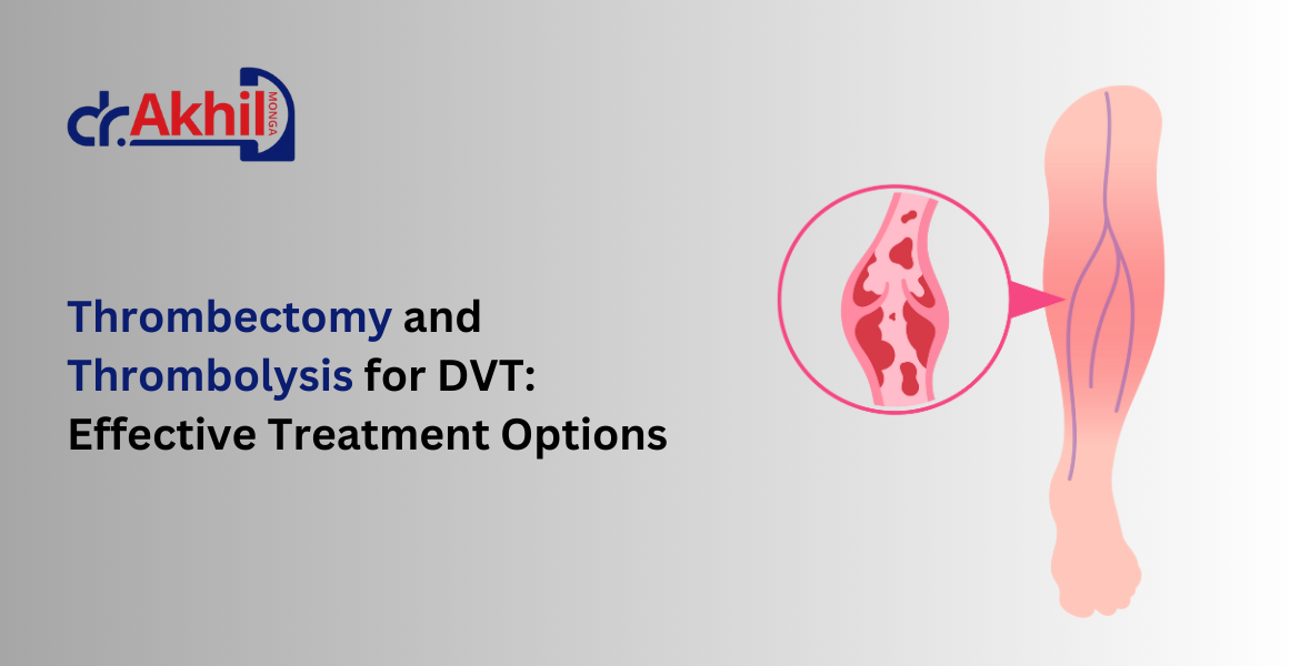 thrombectomy and thrombolysis for dvt