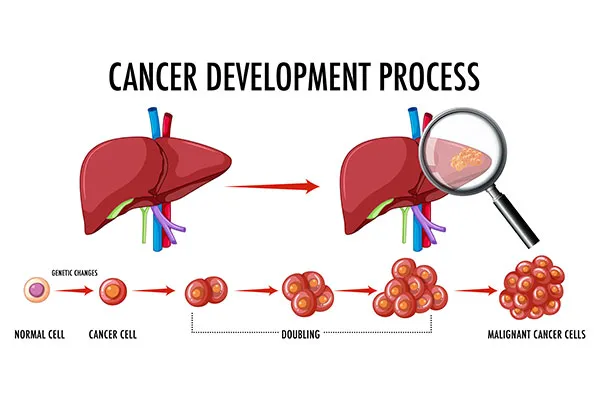 How Does the TACE Procedure Work?