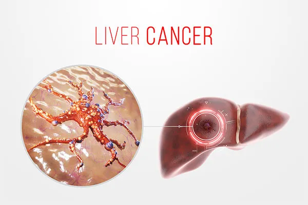 Why Choose TACE for Liver Cancer Treatment?  