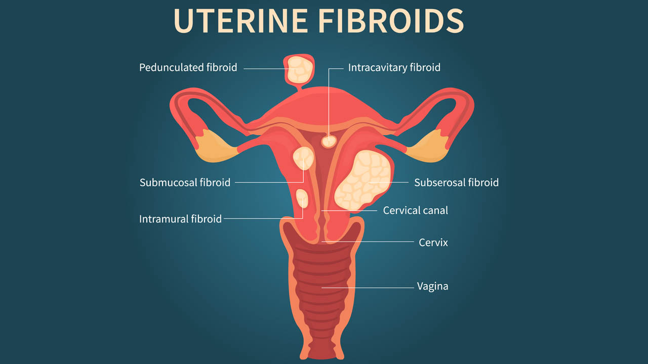 Uterine Fibroid Embolization