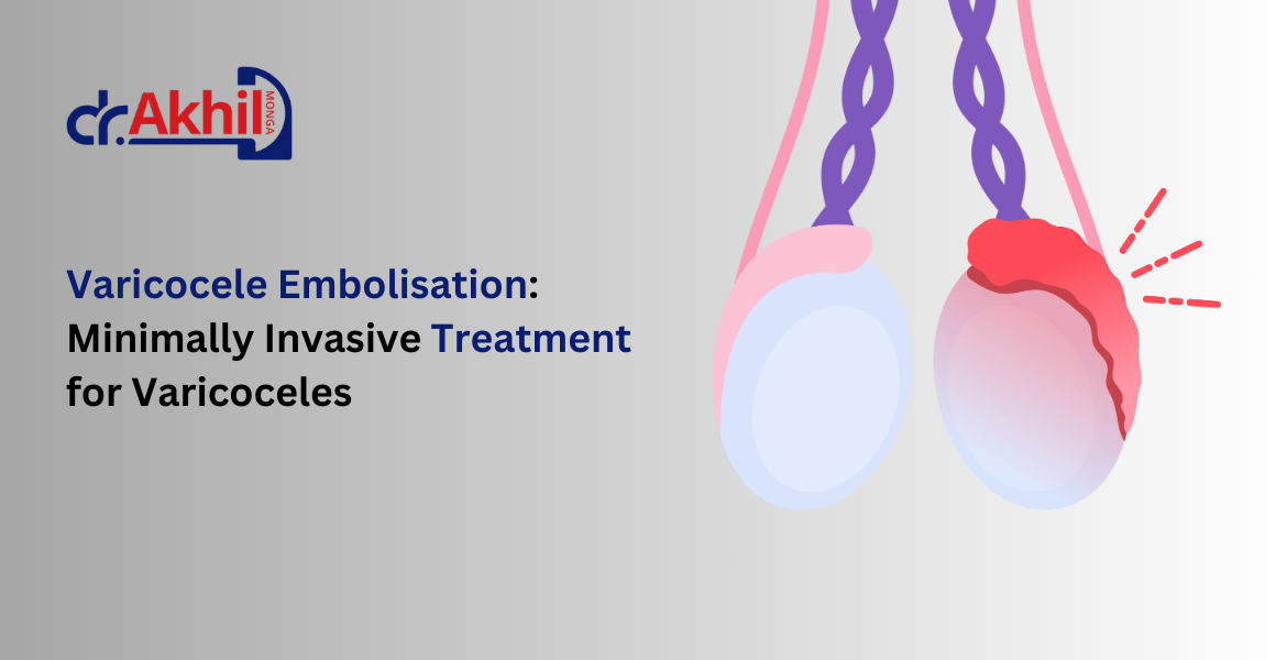 a minimally invasive solution for varicocele embolisation 