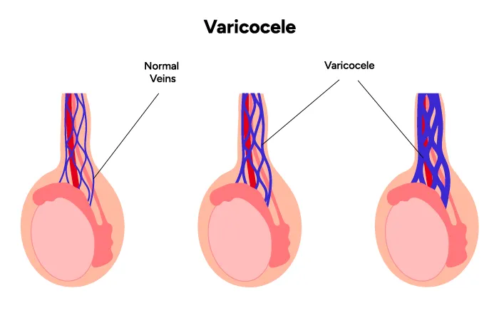 Why Might You Need Varicocele Embolisation?