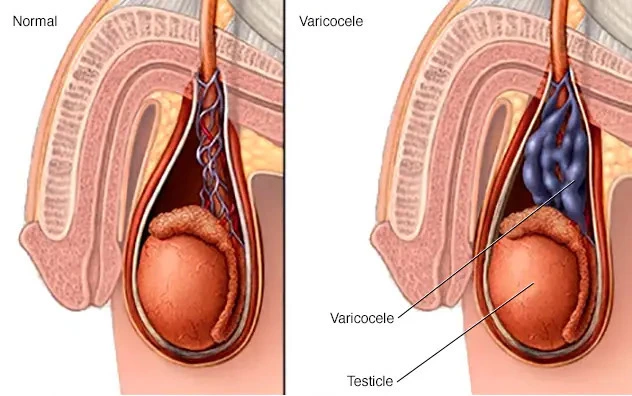 How to treat varicocele without surgery?