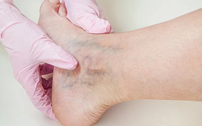 Risks of Varicose Vein Ablation