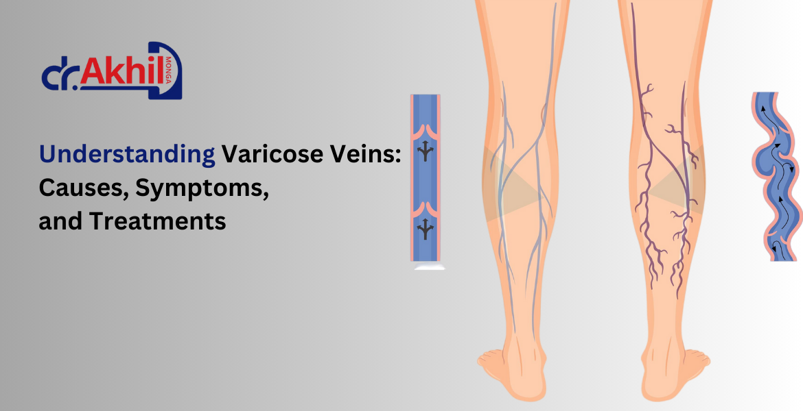 Understanding Varicose Veins: Causes, Symptoms, and Treatments