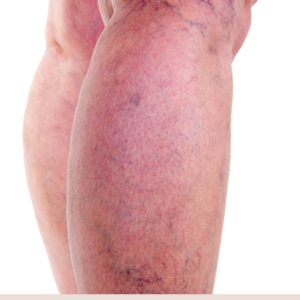 varicose veins