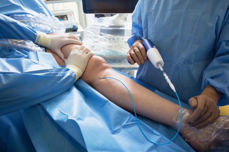 Advantages of VenaSeal Procedure for Varicose Veins