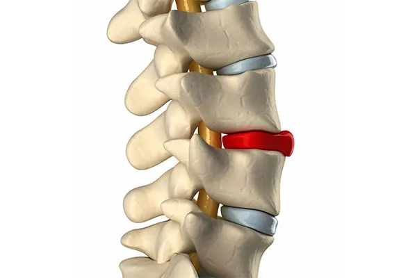 Vertebroplasty