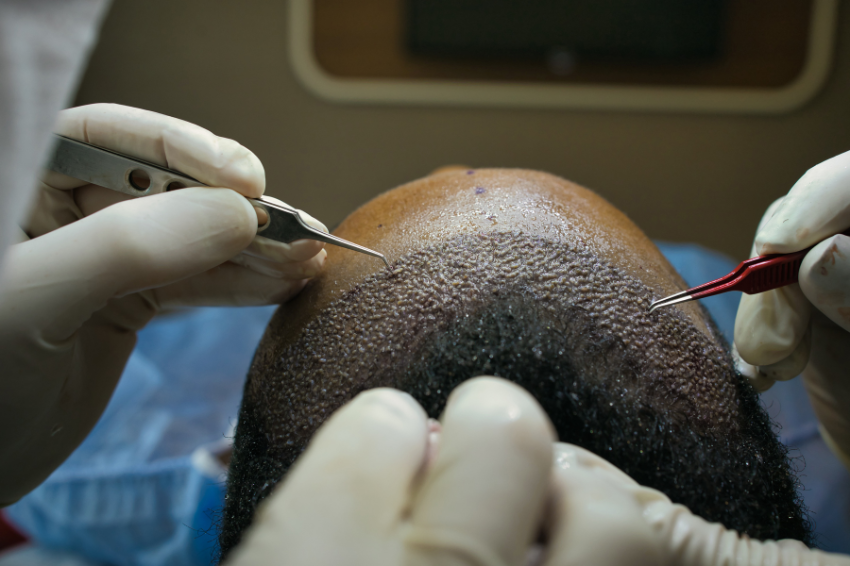 African American Hair Transplant Techniques