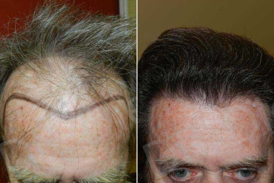Advanced Hair Loss