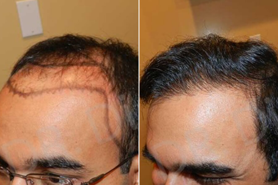 hair follicle surgery