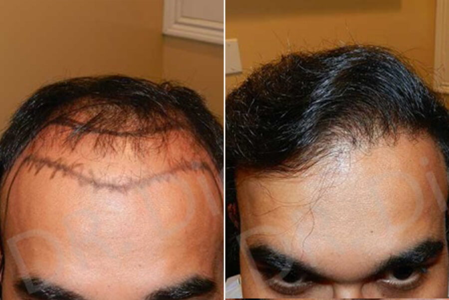 hair follicle surgery