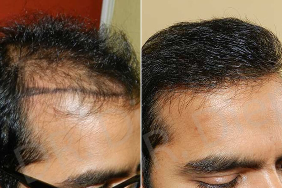 Advanced Hair Loss