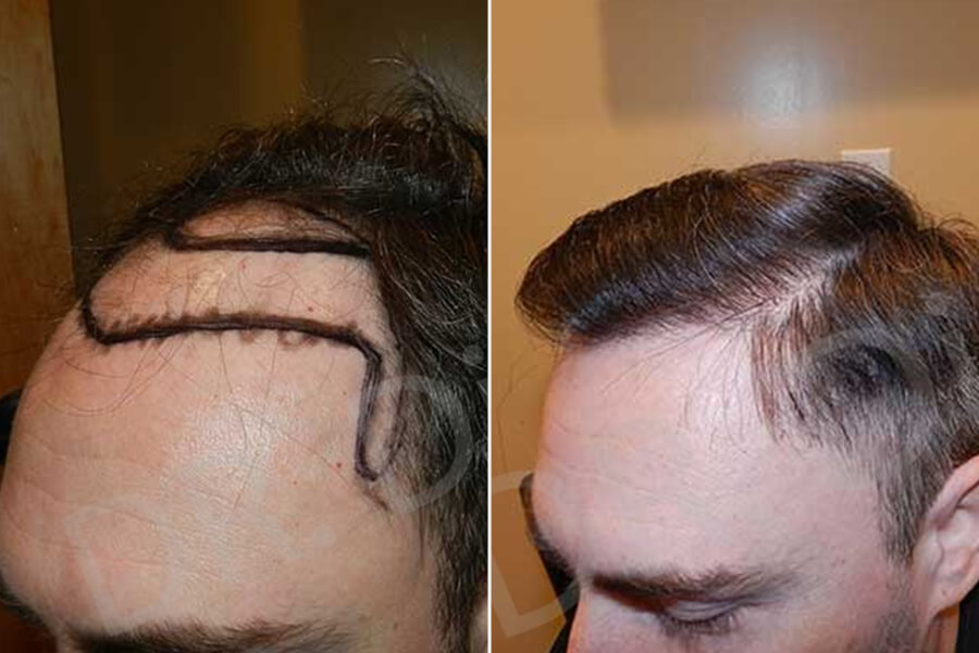 hair restoration san francisco