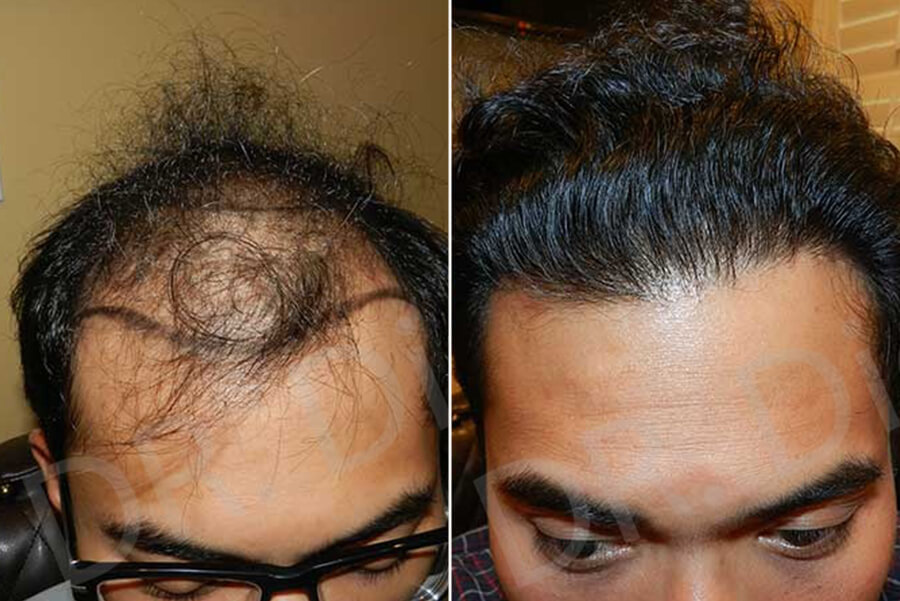 hair replacement near me