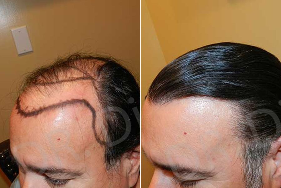 hair replacement near me