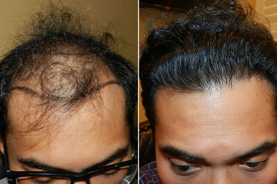 hair restoration near me