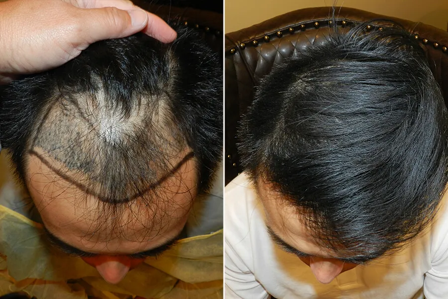 hair restoration san francisco