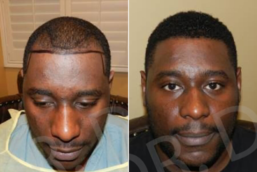 african american hair loss