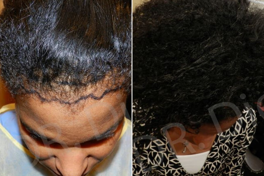 african american hair loss