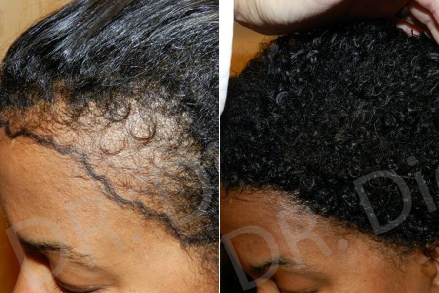 Afro Black Hair Loss