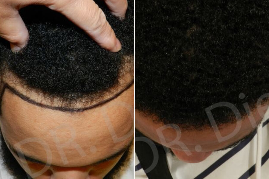 afro receding hairline