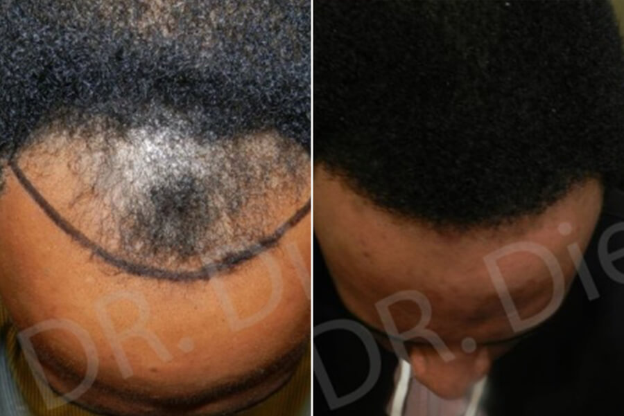treatment for thinning african american hair