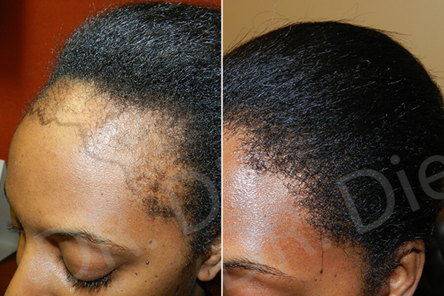 afro hair shedding