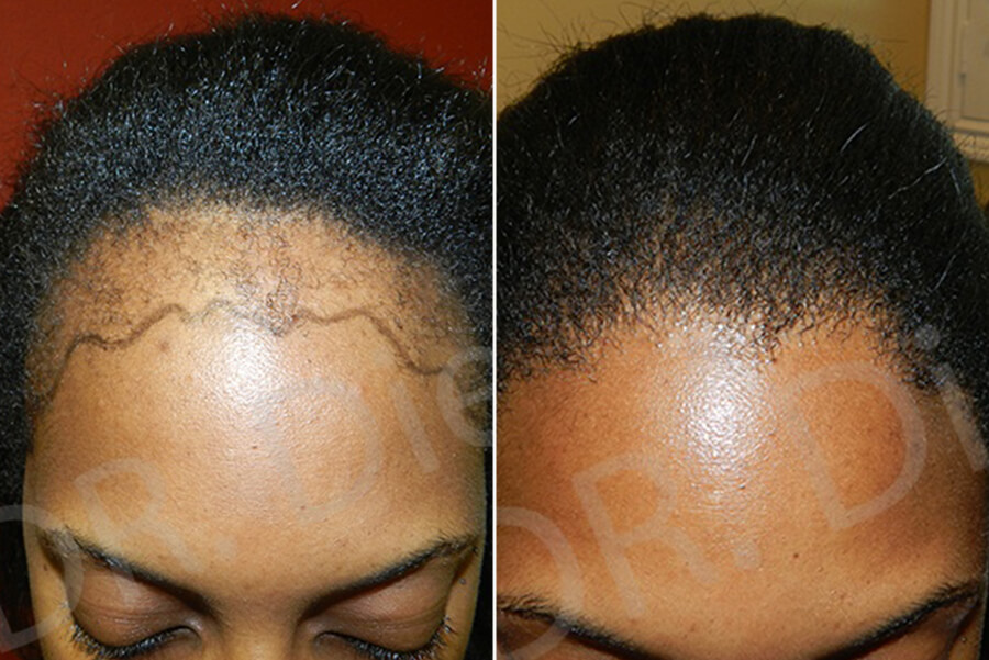 afro hair shedding
