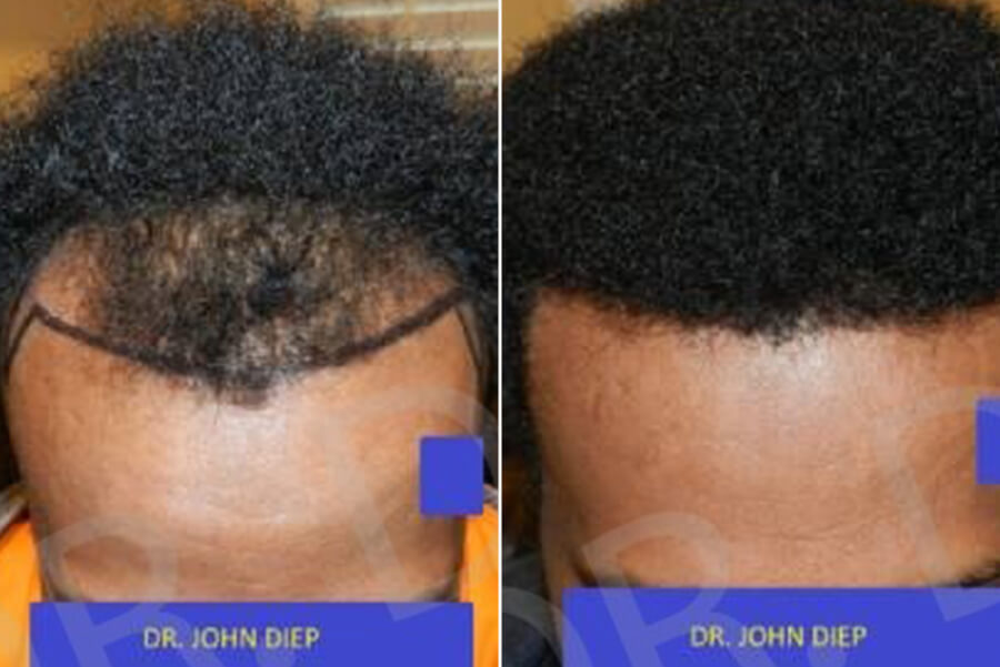 afro hair thinning