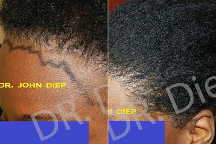 afro thinning