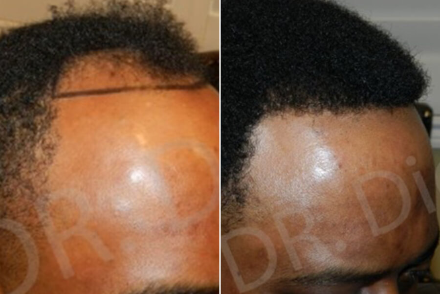 afro hair thinning male