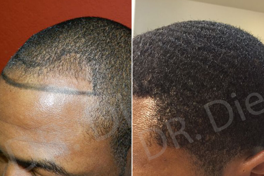 afro hair loss